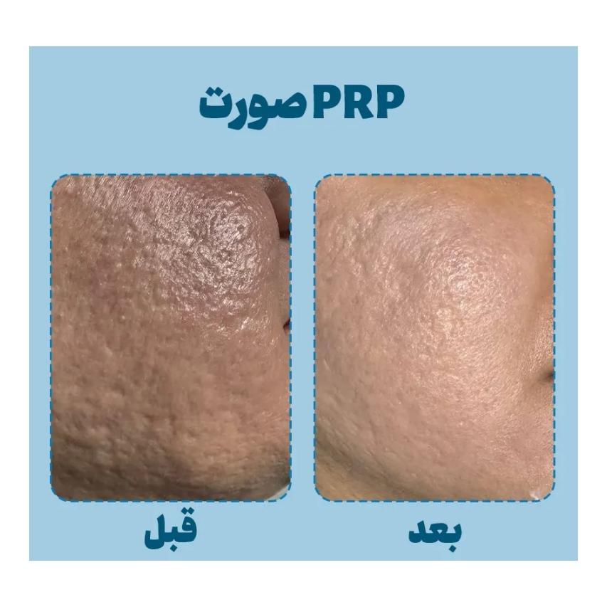 جشنواره پی آر پی prp در مطب پزشک|خدمات آرایشگری و زیبایی|اصفهان, برازنده|دیوار