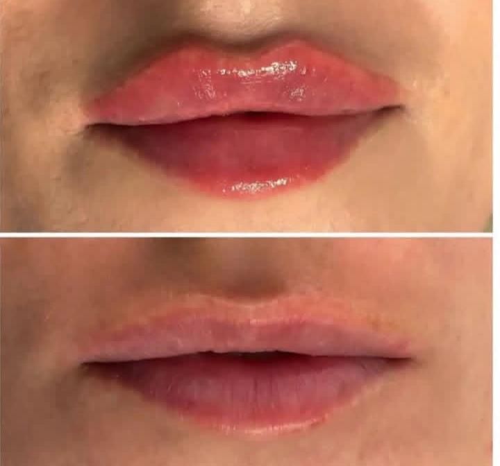 مطب پزشک ژل لب گونه چونه زاویه فک بوتاکس فیلر بینی|خدمات آرایشگری و زیبایی|قم, صفائیه|دیوار