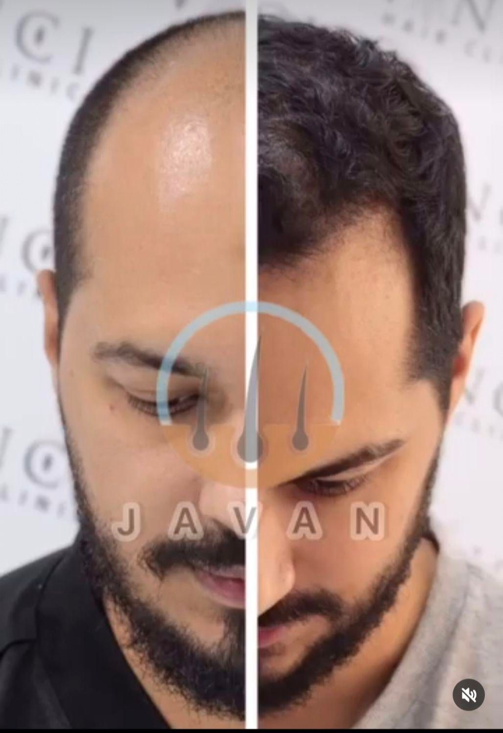 کاشت مو ابرو بلفاروپلاستی مزو تراپی پی آرپی|خدمات آرایشگری و زیبایی|تهران, صادقیه|دیوار