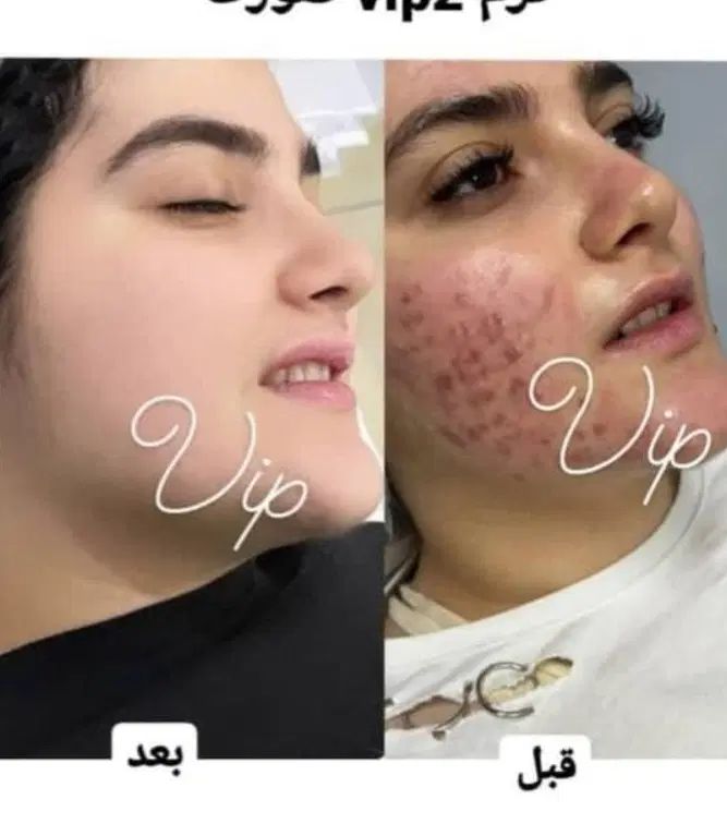 فرمول کرم سفید کننده قوی صورت ودستوپا تضمینی|آرایشی، بهداشتی، درمانی|ایرانشهر, |دیوار