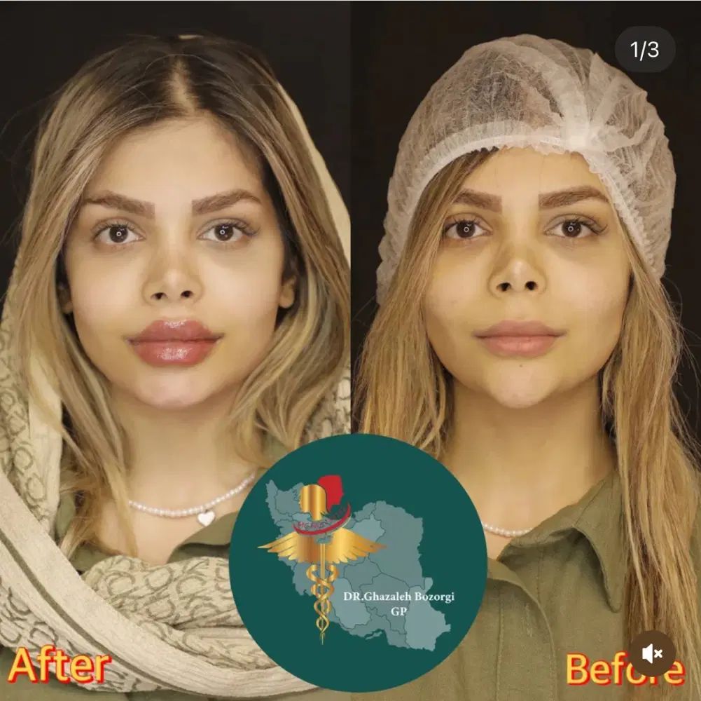 مانکن جهت تزریق لب و کانتورینگ صورت وتزریق چربی|خدمات آرایشگری و زیبایی|تهران, امانیه|دیوار