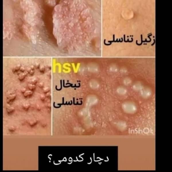 بهبود زگیل تناسلی....|خدمات آرایشگری و زیبایی|گرگان, |دیوار