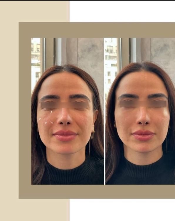 لیزر موهای زائد با قیمت باور نکردنی 550 فول بادی|خدمات آرایشگری و زیبایی|کرج, گلشهر|دیوار