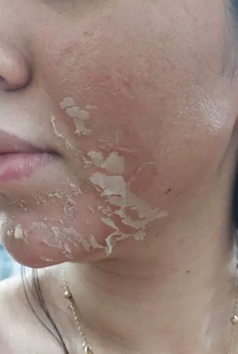 آموزش و خدمات تکنیک پوست مار و مزونیدلینگ|خدمات آرایشگری و زیبایی|اسلام‌شهر, باغ فیض|دیوار