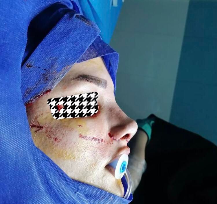 جراحی بینی عمل بینی انواع جراحی زیبایی|خدمات آرایشگری و زیبایی|ساری, |دیوار