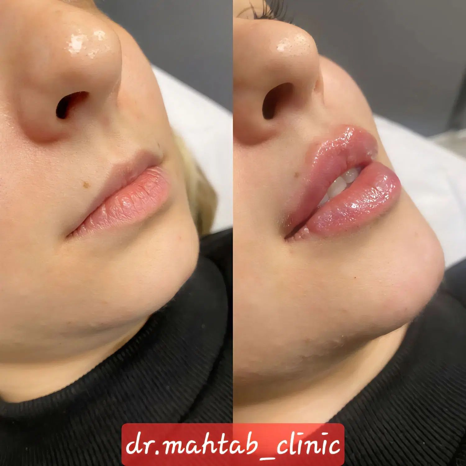 تخفیف ویژه فیلر لب و کانتورینگ|خدمات آرایشگری و زیبایی|کرج, کوی زنبق|دیوار