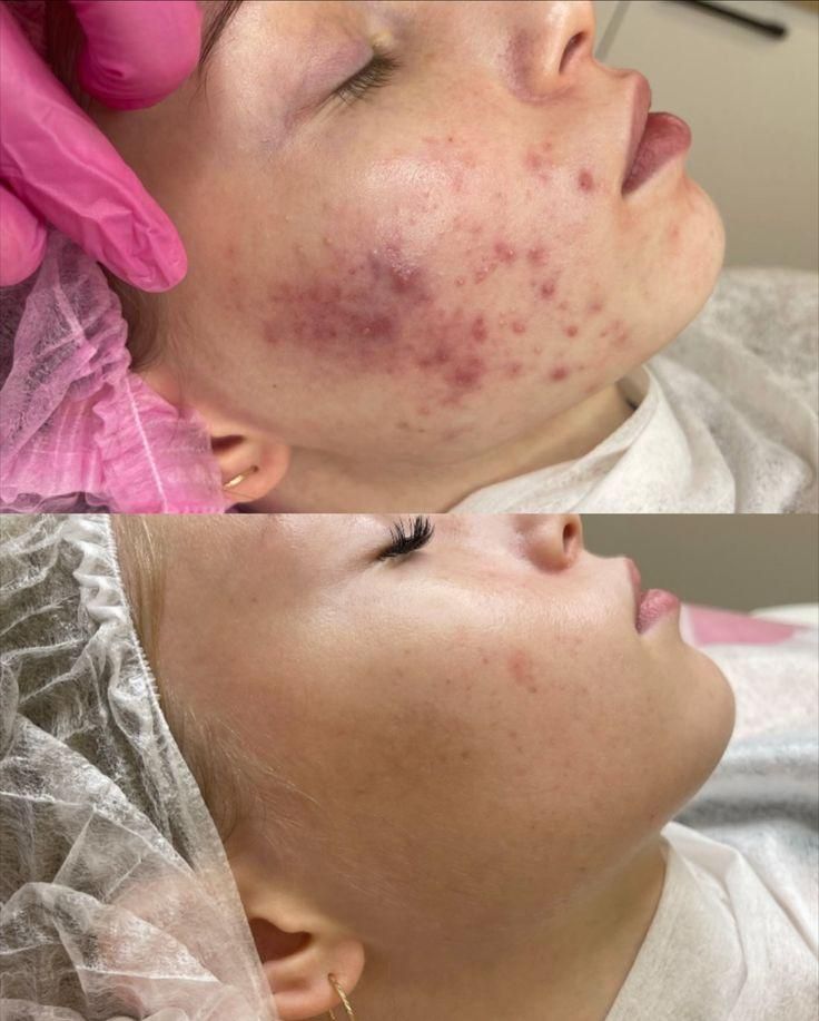 نیازمند مدل پاکسازی فقد هزینه متریال گرفته میشه|خدمات آرایشگری و زیبایی|امیدیه, |دیوار