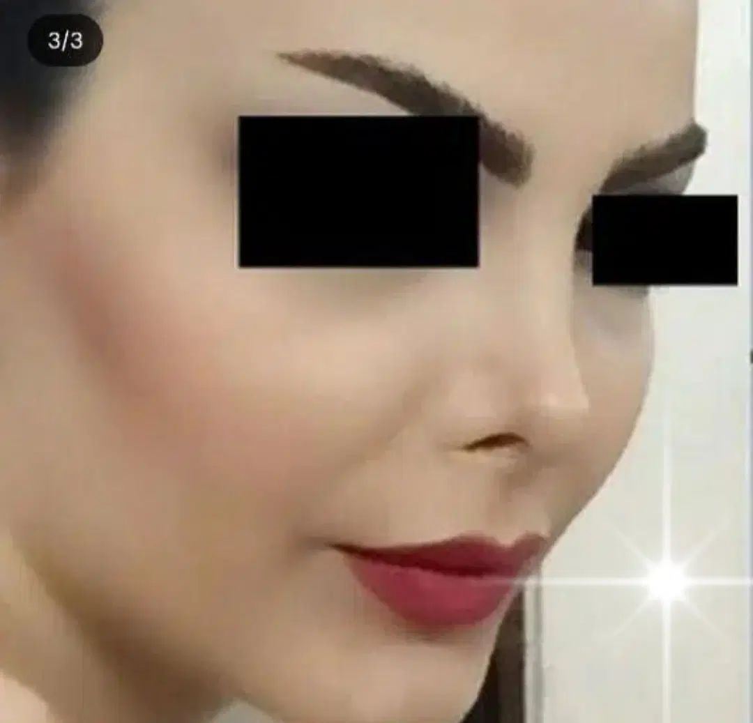 عمل بینی (پیکر تراشی تخصصی) لیپو لیفت پروتز سینه|خدمات آرایشگری و زیبایی|تهران, فلسطین (میدان انقلاب)|دیوار
