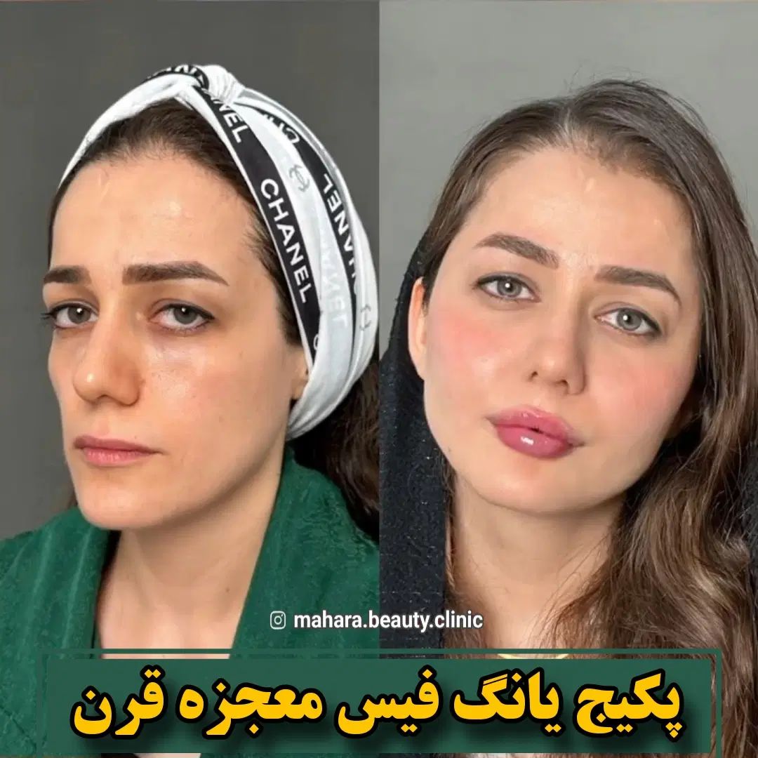 تخفیف یانگ فیس صورت ابرو پزشک پوست مو بینی زیبایی|خدمات آرایشگری و زیبایی|مشهد, هفت تیر (آب و برق)|دیوار