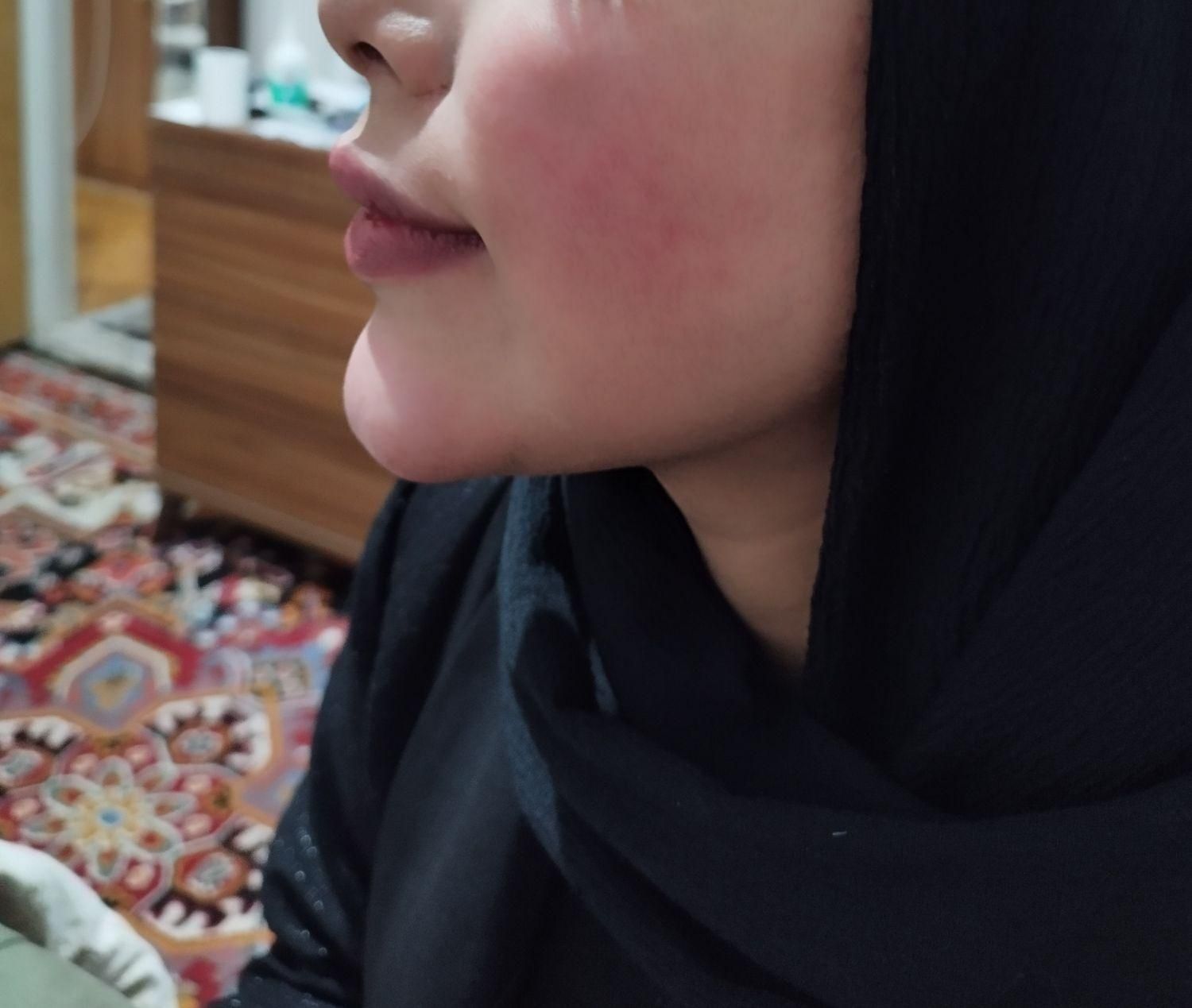 جشنواره تزریق ژل بدون درد و کبودی تضمینی|خدمات آرایشگری و زیبایی|جیرفت, |دیوار