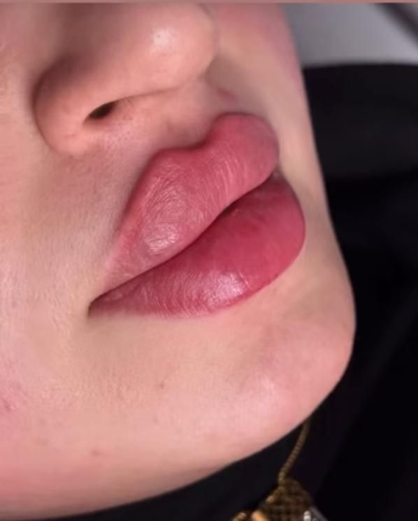 ژل بوتاکس سی سی ۵۰۰|خدمات آرایشگری و زیبایی|قرچک, میرزائی جنوبی|دیوار