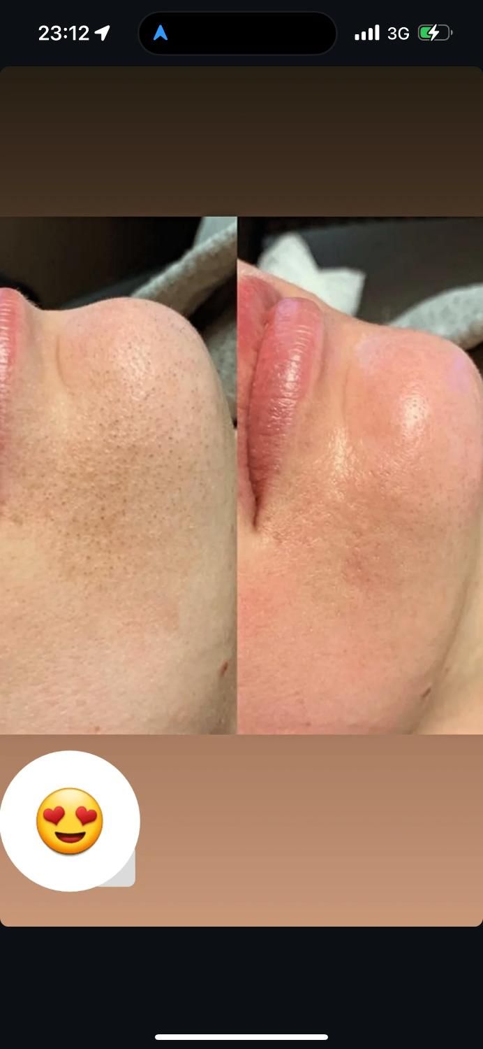 پاکسازی پوست به صورت تخصصی(بانوان)|خدمات آرایشگری و زیبایی|مشهد, آبکوه|دیوار