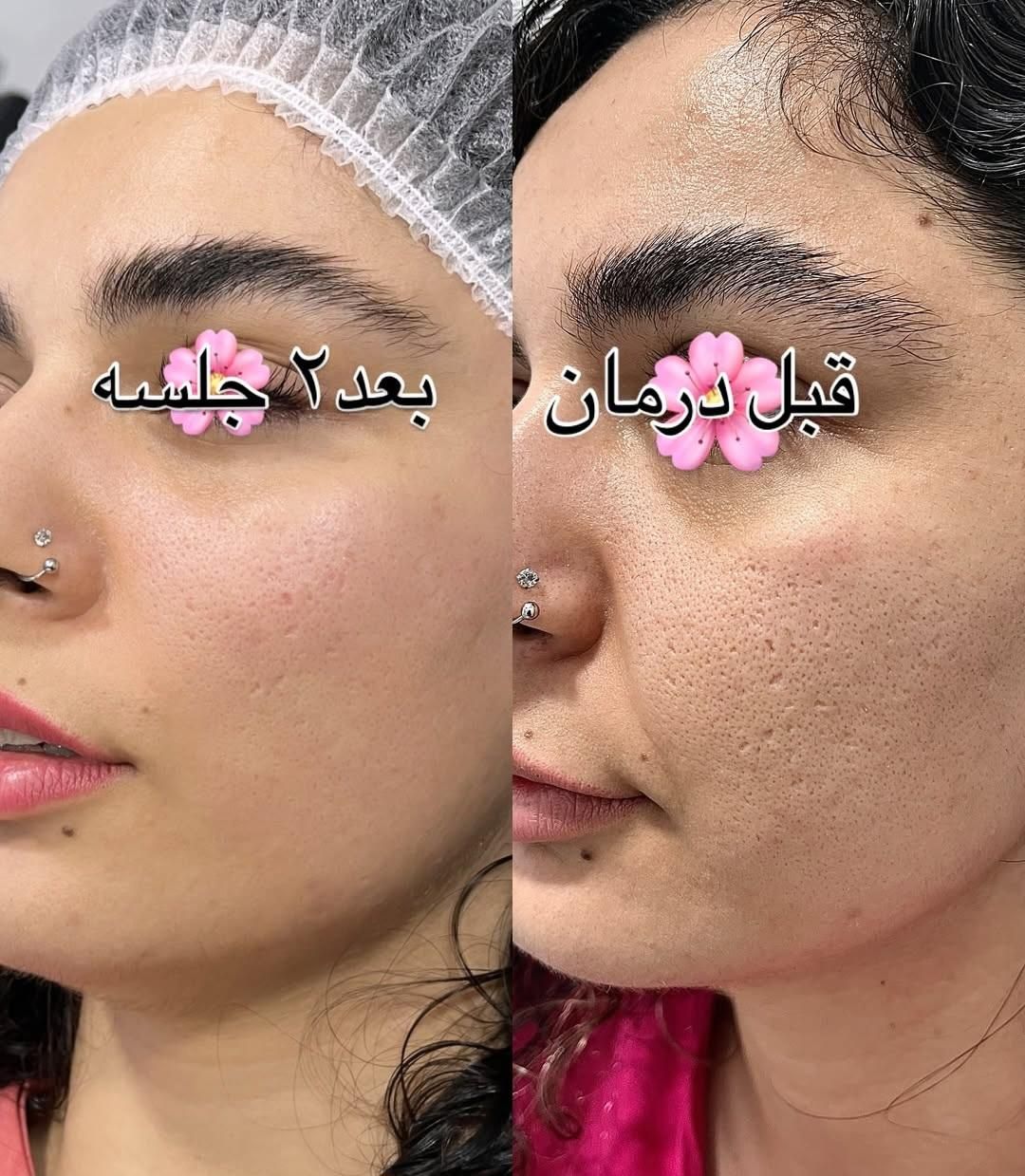 پاکسازی و فیشال /درمان جوش و لک و منافذباز|خدمات آرایشگری و زیبایی|کرمانشاه, |دیوار