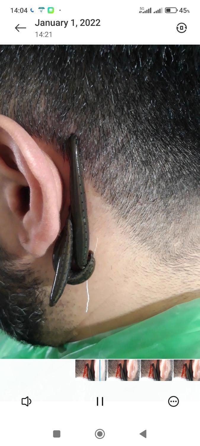 حجامت،فصدخون،زالو درمانی،طب سنتی|خدمات آرایشگری و زیبایی|تهران, تهرانسر شمالی|دیوار