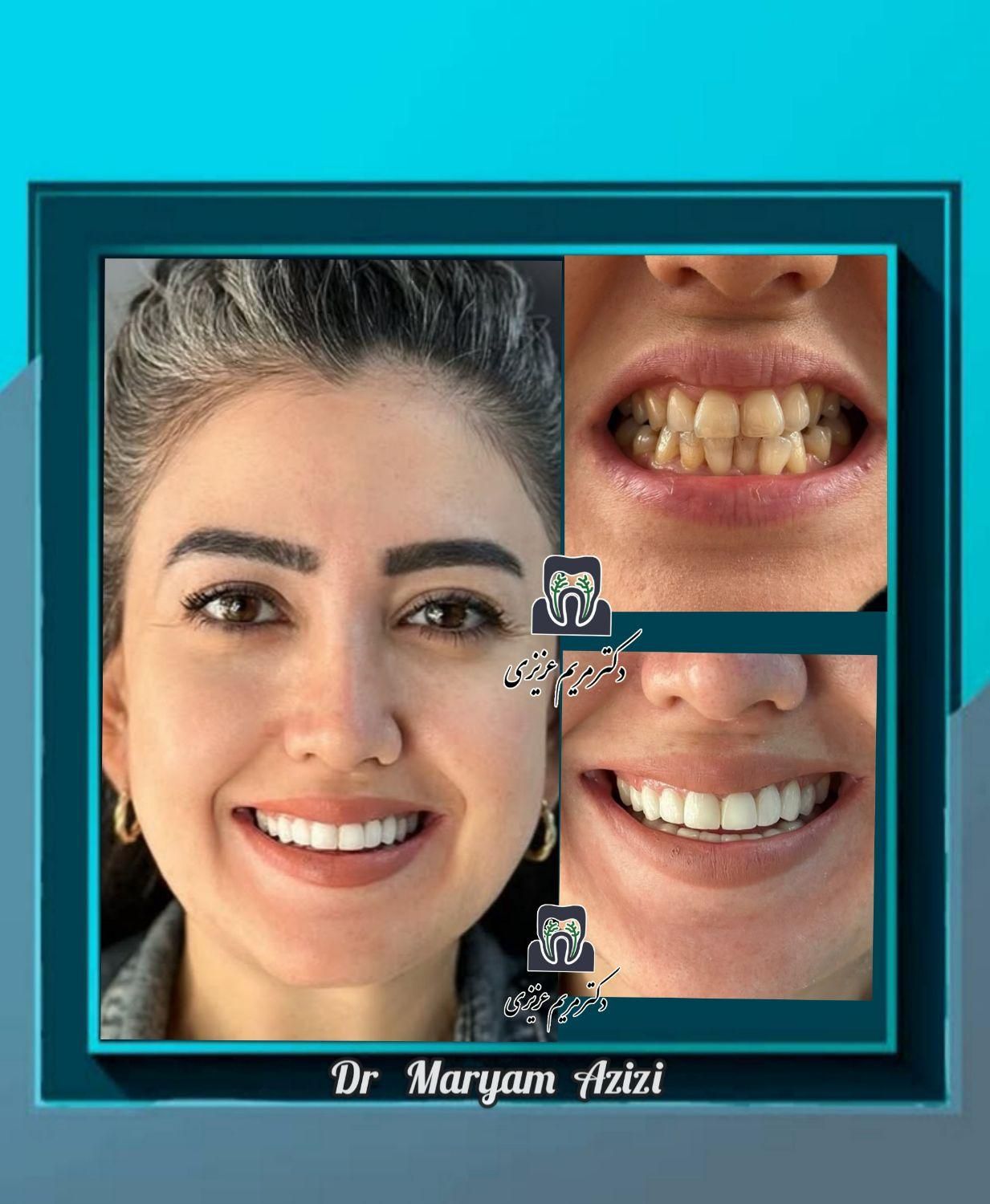 دندانپزشکی زیبایی و درمانی لمینت کامپوزیت دندان|خدمات آرایشگری و زیبایی|شیراز, معالی‌آباد|دیوار