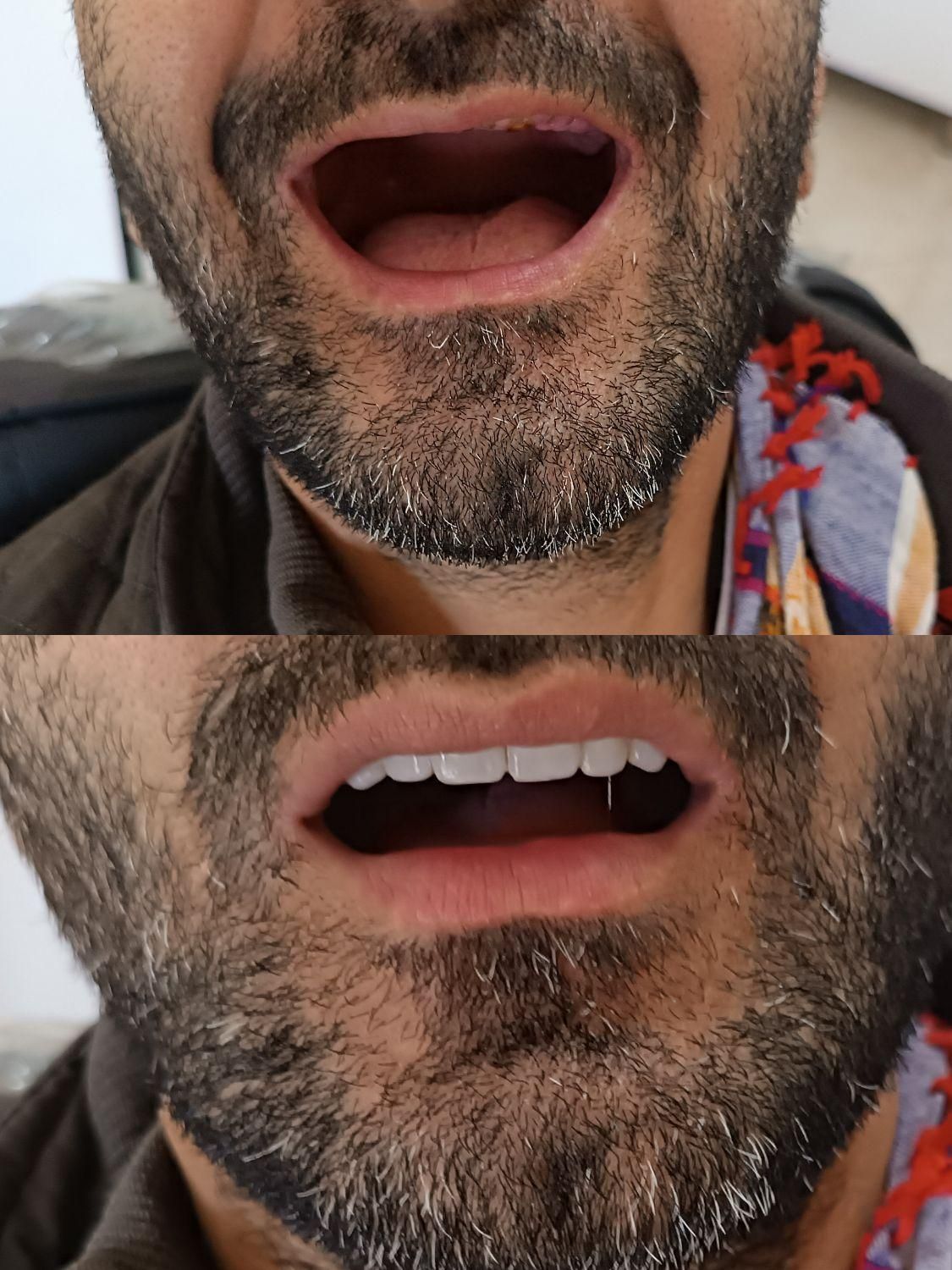 دندانسازی پیرهادی بامتد جدید کنترل لقی دندان|خدمات آرایشگری و زیبایی|ورامین, ورامین|دیوار