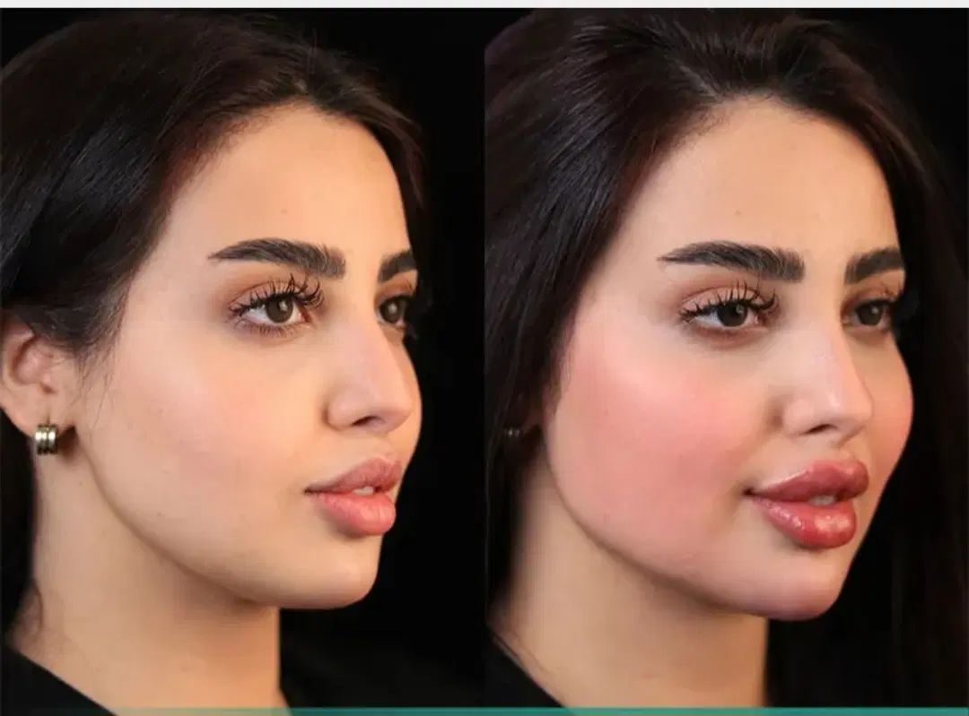 فول فیس ژل لب فیلربیکینی تخفیفات فقط دو روز|خدمات آرایشگری و زیبایی|مشهد, احمدآباد|دیوار