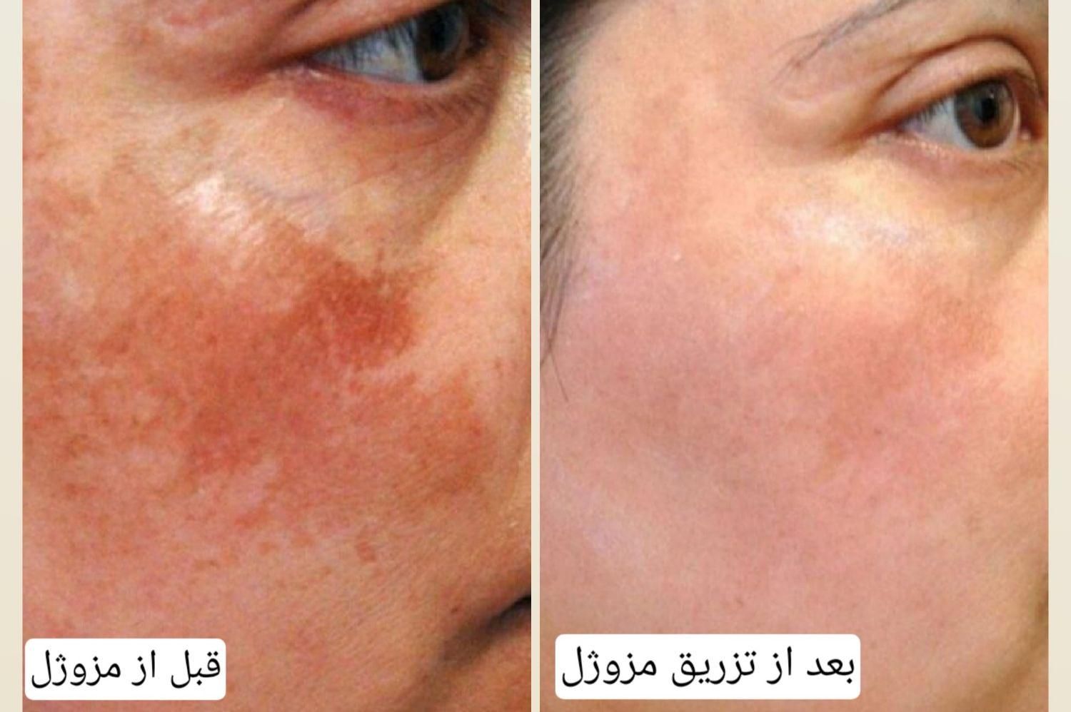 تزریق مزوژل روشن‌کننده جوانساز وبوتاکس|خدمات آرایشگری و زیبایی|آبادان, |دیوار