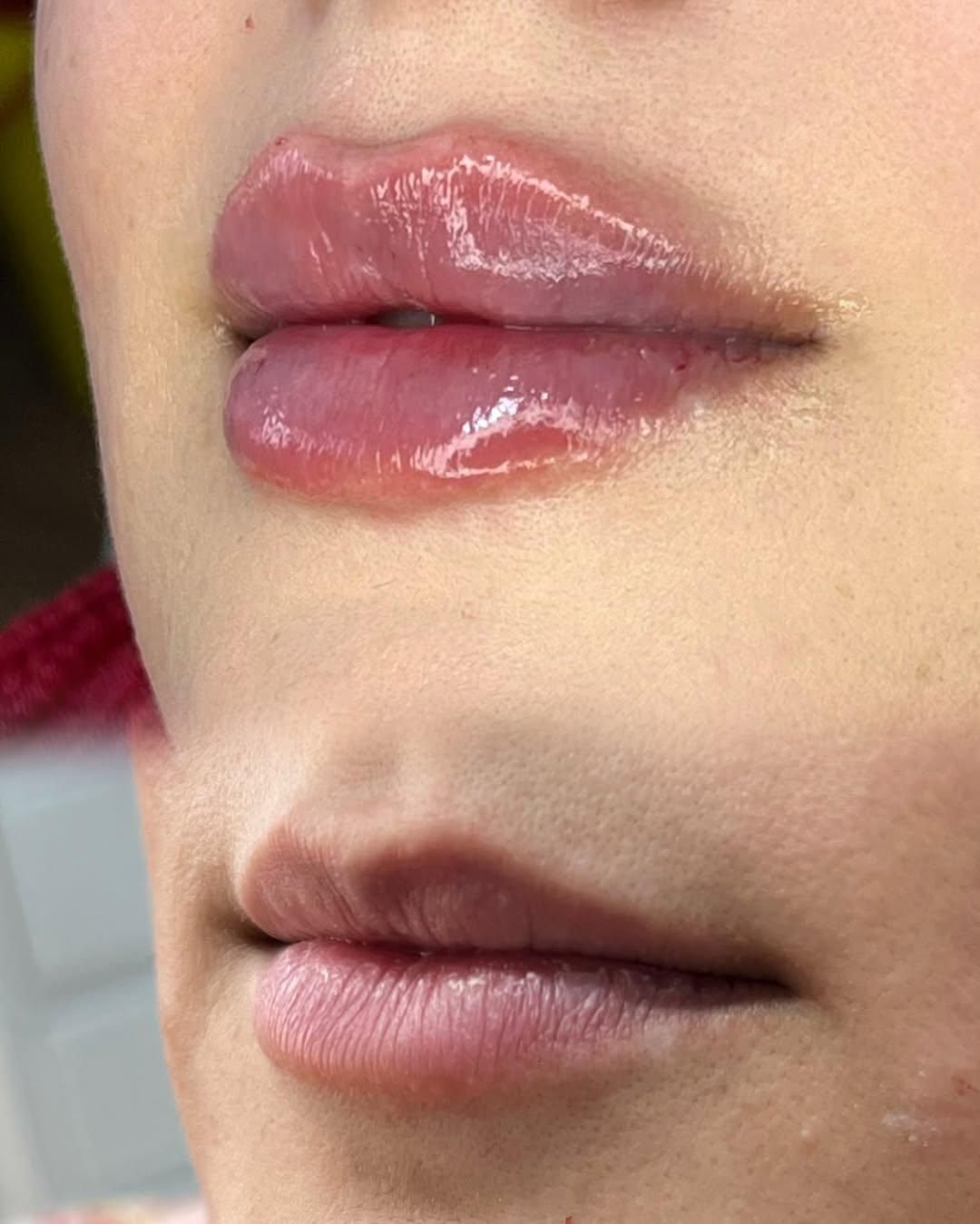 تزریقات ژل .بوتاکس .آنزیم .مزو ژل .مزوسر ضمانتی|خدمات آرایشگری و زیبایی|خرم‌آباد, |دیوار