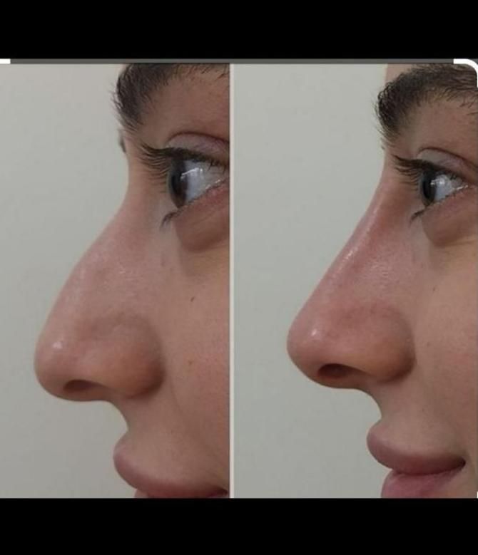طراحی لیفت بینی وفرمدهی عملی(بدون جراحی)پزشک متخصص|خدمات آرایشگری و زیبایی|مشهد, سناباد|دیوار