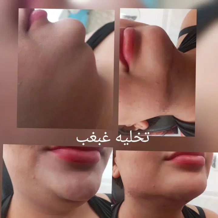 تزریق تخصصی ژل لب تزریق بادی لیفت نخ و چربی|خدمات آرایشگری و زیبایی|خرمشهر, |دیوار