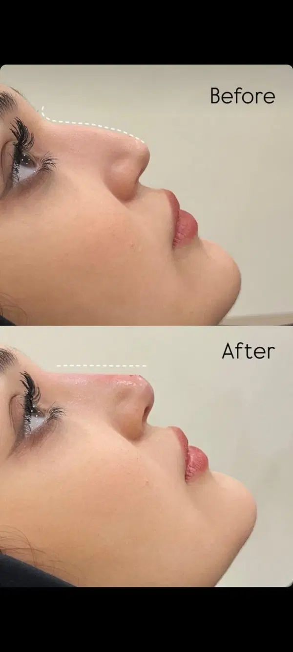 ژل بوتاکس آنزیم مزوتراپی پرسینگ فشیال فیلر|خدمات آرایشگری و زیبایی|مشهد, صیاد شیرازی|دیوار