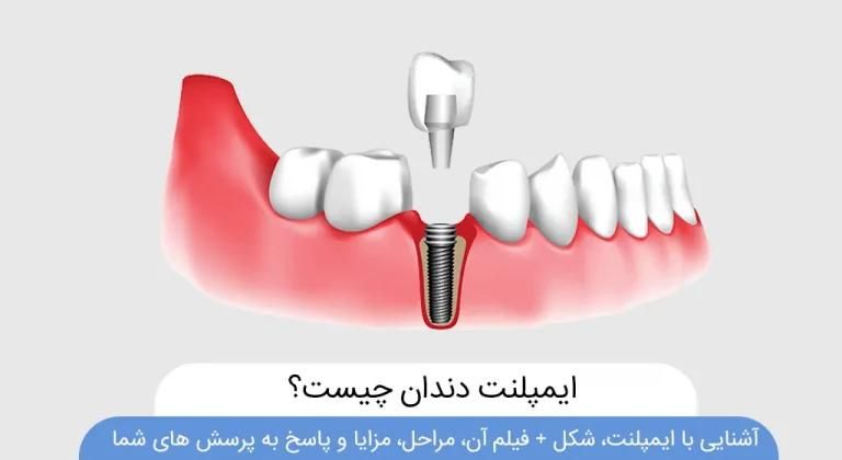 ایمپلنت دندان ۷۹۰۰ با ضمانت ۲۰ ساله|خدمات آرایشگری و زیبایی|کرج, عظیمیه|دیوار