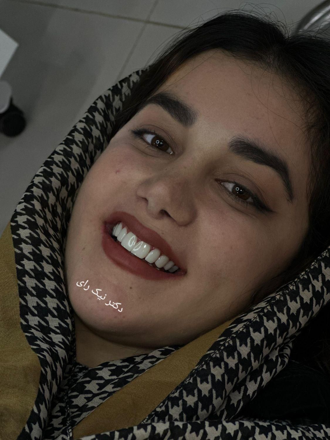 کامپوزیت زیبایی کامپوزیت دندان باضمانت کتبی ۵ ساله|خدمات آرایشگری و زیبایی|همدان, |دیوار