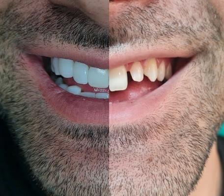 خدمات دندانپزشکی، کامپوزیت ،لمینیت|خدمات آرایشگری و زیبایی|تهران, حکمت|دیوار