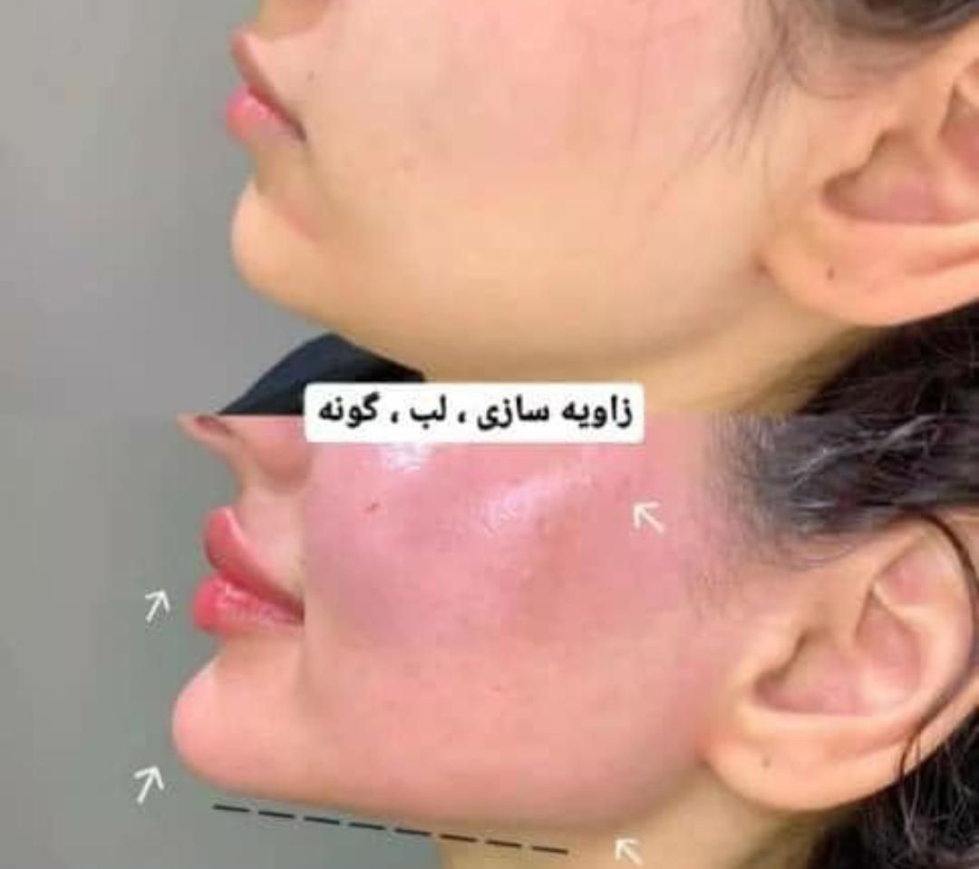 آموزش ژل و بوتاکس. لیفت صورت بانخ (کلینیک)|خدمات آرایشگری و زیبایی|بندرعباس, |دیوار
