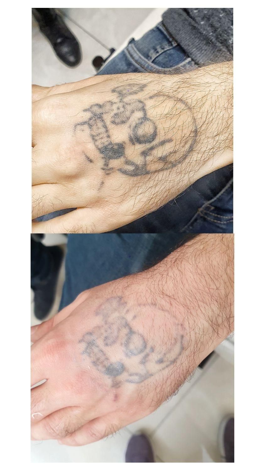 پاک کردن تتو با لیزر کیوسوییچ تضمینی|خدمات آرایشگری و زیبایی|تهران, نیروی هوایی (پیروزی)|دیوار