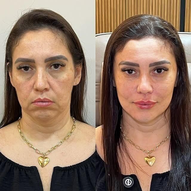تزریق ژل و بوتاکس طراحی چهره برای زیبایی‌خاص|خدمات آرایشگری و زیبایی|تهران, شادمان|دیوار