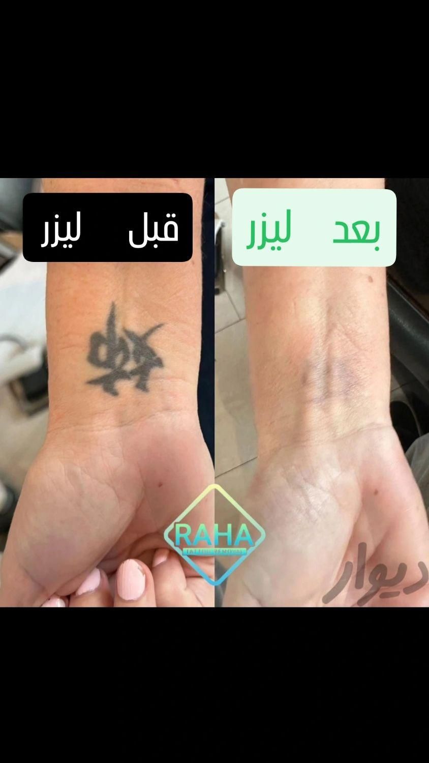 کلینیک پاک کردن تاتو(لیزرتضمینی)دریک جلسه/ریموابرو|خدمات آرایشگری و زیبایی|مشهد, احمدآباد|دیوار