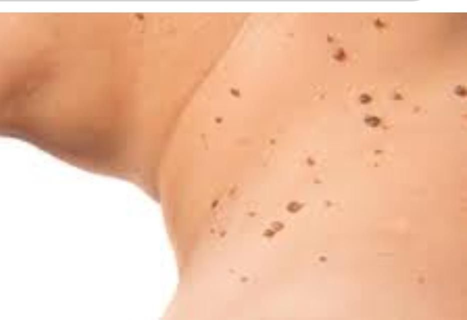 فروش مواد زگیل تناسلی تضمینی با ی بار استفاده|خدمات آرایشگری و زیبایی|یاسوج, |دیوار