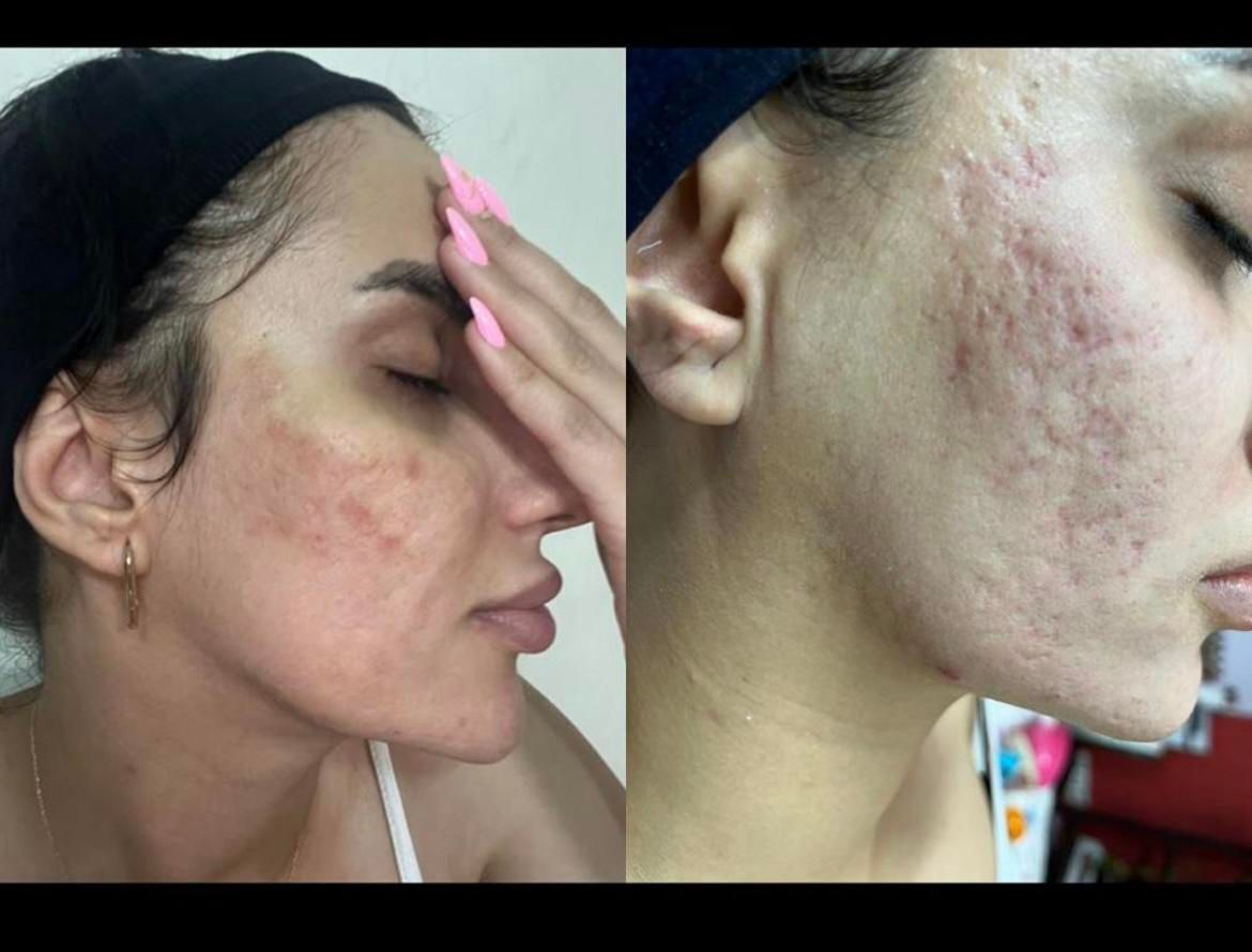 زیبایی.پی ارپی جوانسازی و ژل و بوتاکس.|خدمات آرایشگری و زیبایی|اصفهان, شهرک کاوه|دیوار