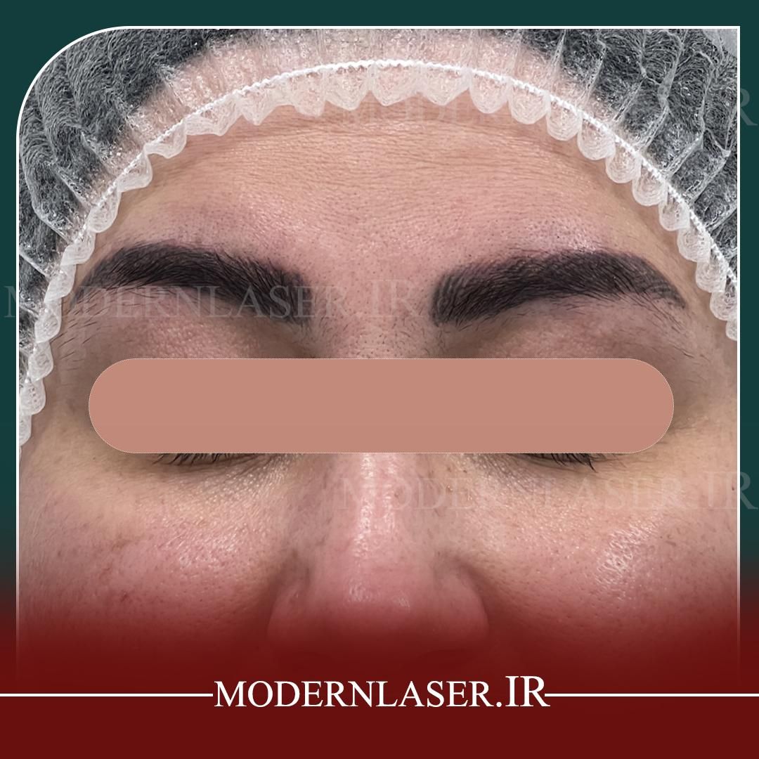 ریموو انواع تتو و خالکوبی بدون هیچ اثری توسط پزشک|خدمات آرایشگری و زیبایی|اصفهان, سعادت‌آباد|دیوار