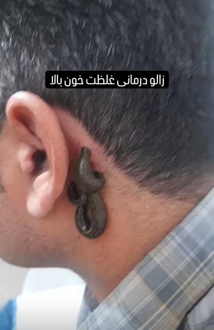 حجامت زالو درمانی بادکش گرم کلنیک شفا خانم باقری|خدمات آرایشگری و زیبایی|زابل, |دیوار