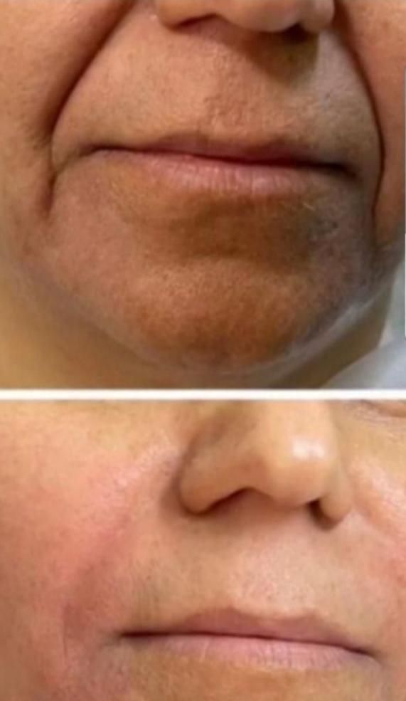 ساکشن چربی و تزریق ژل و بوتاکس و مزو لیفت شقیقه و.|خدمات آرایشگری و زیبایی|کرمانشاه, |دیوار