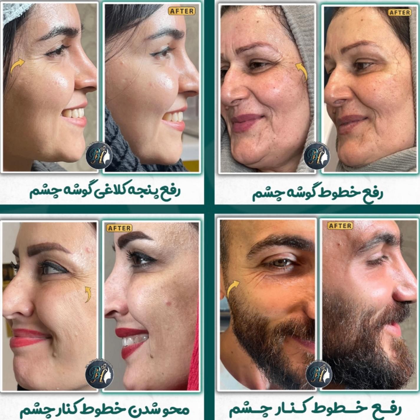 بوتاکس فیلر(ژل) مزوتراپی، پی ار پی درمطب گلسار رشت|خدمات آرایشگری و زیبایی|رشت, گلسار|دیوار