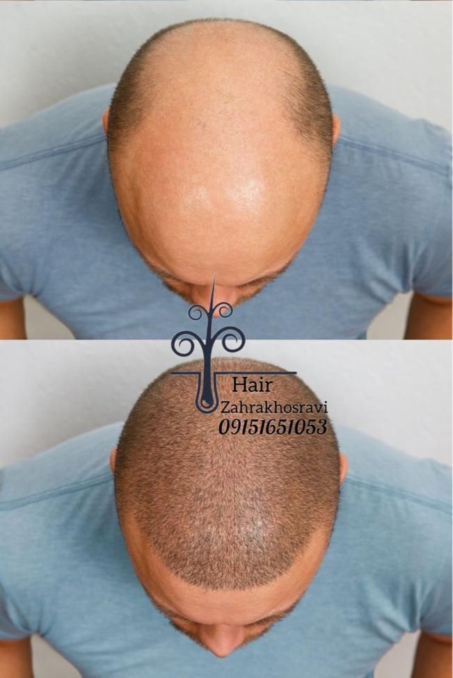 کاشت مو،ابرو،ریش|خدمات آرایشگری و زیبایی|بیرجند, |دیوار