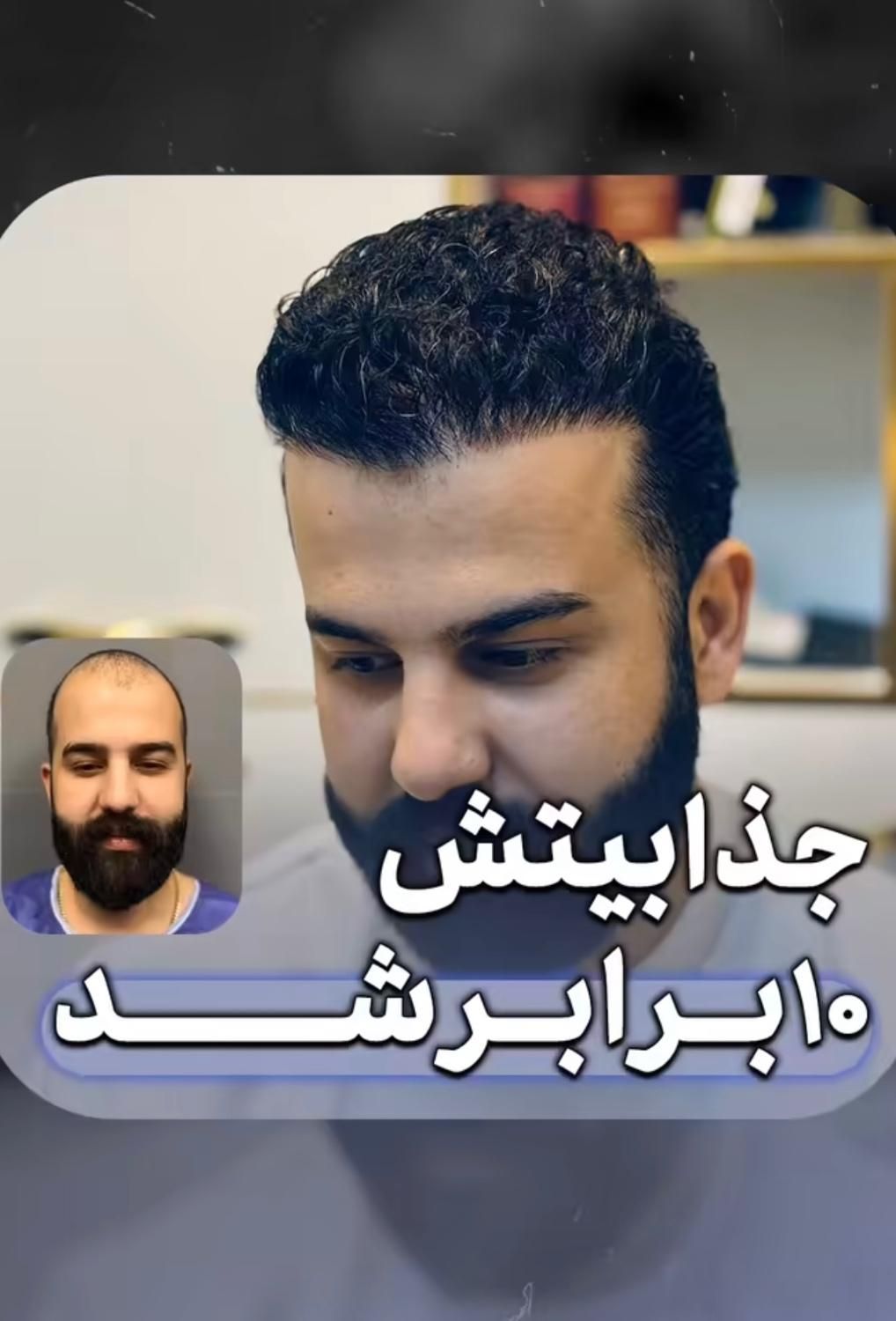 کاشت مو با جدید ترین تکنیک|خدمات آرایشگری و زیبایی|دزفول, |دیوار