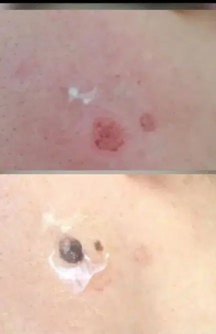 برداشتن خال ومنگوله های پوستی ولکه های سطحی بالیزر|خدمات آرایشگری و زیبایی|الیگودرز, |دیوار