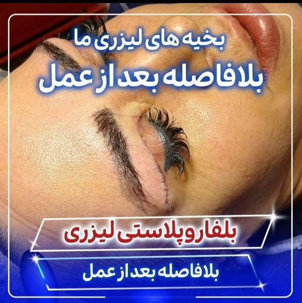 بلفاروپلاستی(جراحی پلک بالا و پایین)توسط چشم پزشک|خدمات آرایشگری و زیبایی|یاسوج, |دیوار