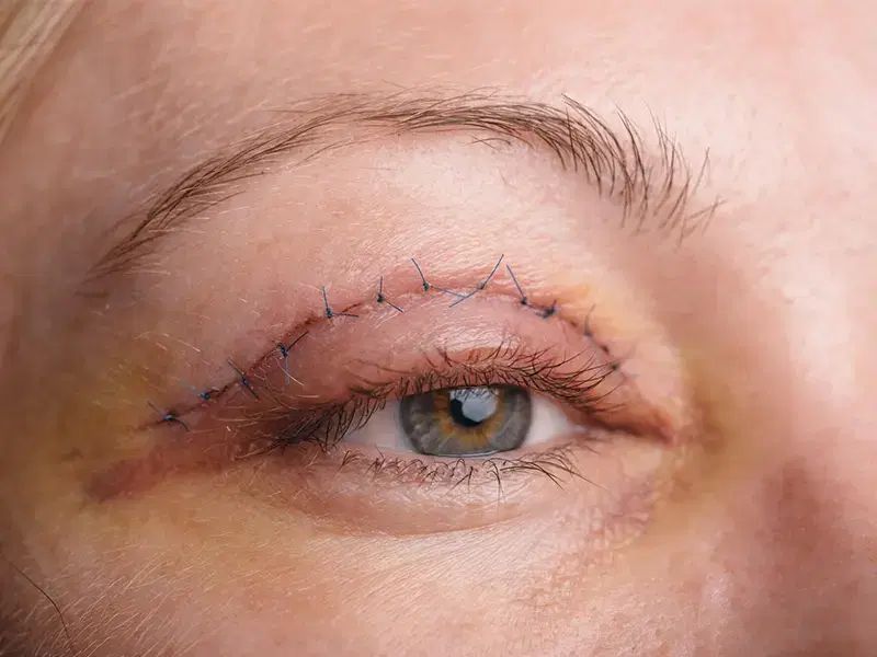 بلفاروپلاستی و خدمات لاغری و زیبایی اندام|خدمات آرایشگری و زیبایی|کرمانشاه, |دیوار