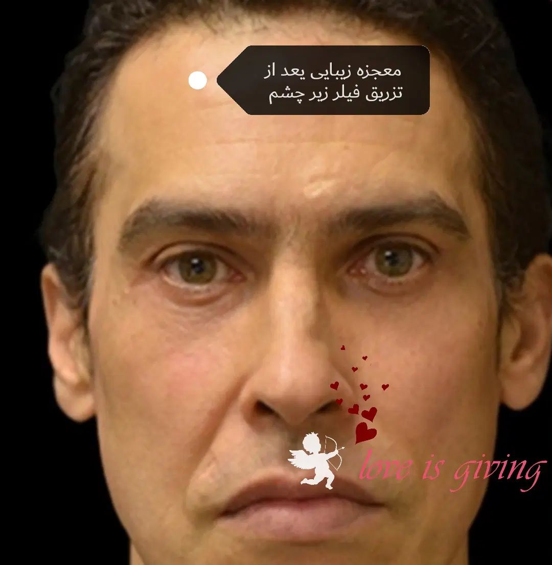 ژل لب روسی،بوتاکس بالیوودی، فیلرزیر چشم،لیفت شقیقه|خدمات آرایشگری و زیبایی|مشهد, سرافرازان|دیوار