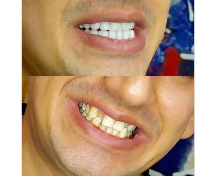 کامپوزیت دندان|خدمات آرایشگری و زیبایی|اندیشه, شهرک صدف|دیوار