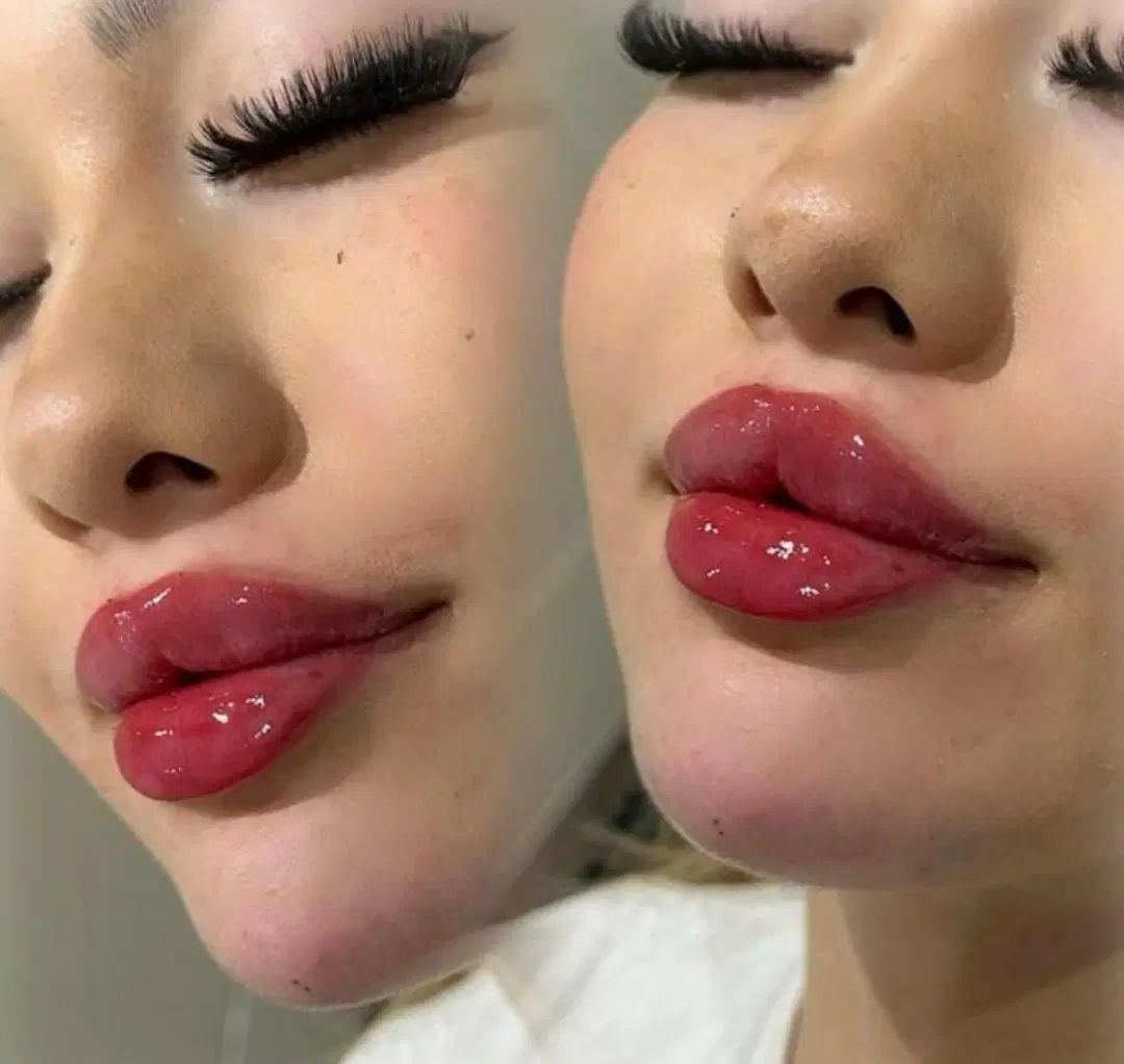 آموزش ژل بوتاکس نخ مزولیفت پی آرپی لیزرآنزیم پزشک|خدمات آموزشی|کرج, گوهردشت|دیوار