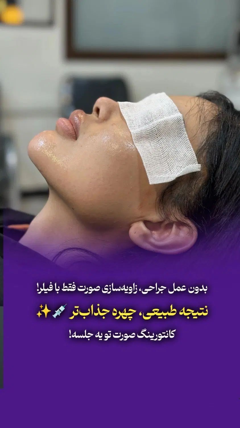 لیفت ابرو با نخ ، ژل لب ، بوتاکس توسط پزشکان متخصص|خدمات آرایشگری و زیبایی|تهران, صادقیه|دیوار