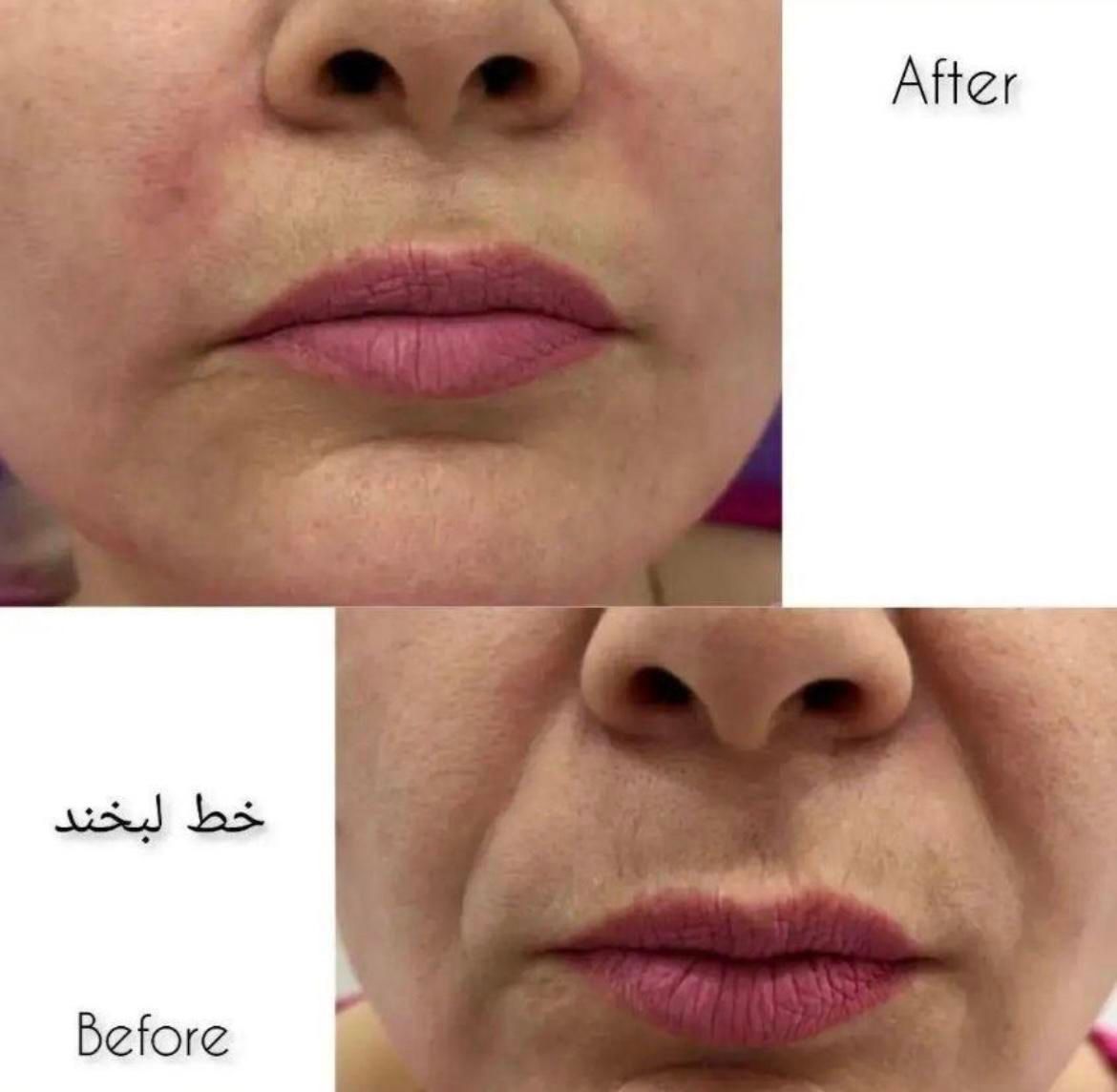 تخفیفات خدمات فیلر و بوتاکس کلینیک|خدمات آرایشگری و زیبایی|شاهین‌شهر, فردوسی|دیوار