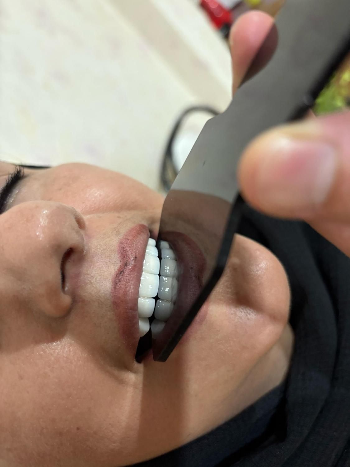 روکش های دندانی(پروتز های دندانی)|خدمات آرایشگری و زیبایی|ارومیه, |دیوار